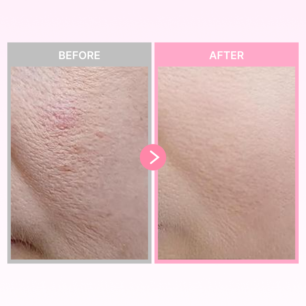 MOIDA SET [MOIDA] Pink Collagen PDRN Anti-Aging Care Set for Sagging & Dull Skin (AGE-R Device + Cleansing Foam + Booster Shot + Serum + Night Mask) *Special Price*