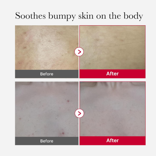 [Medicube] Red Acne Body Peeling Shot 2.0 110ml