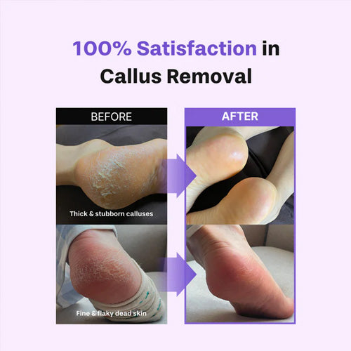 [baren] Callus Remover Kit for Feet: Foot File & Peeling Foot Spray *Flash Deal*