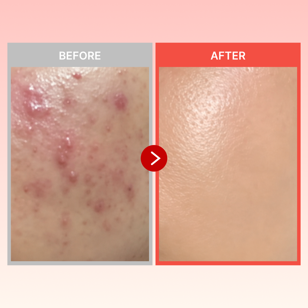 MOIDA SET [MEDICUBE] Red Acne Care Routine for Blemish-Prone & Sensitive Skin (Cleansing Foam + Peeling Pad + Cream) *Special Price*
