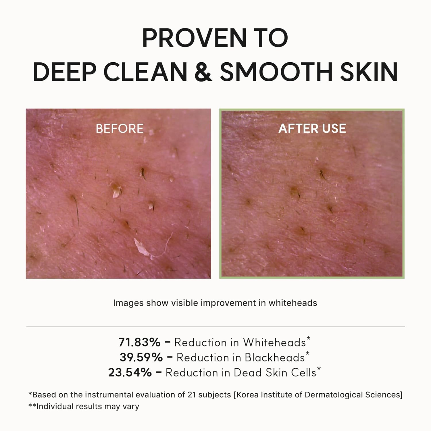 MOIDA SET [MOIDA] Acne Reset Set *Special Price*
